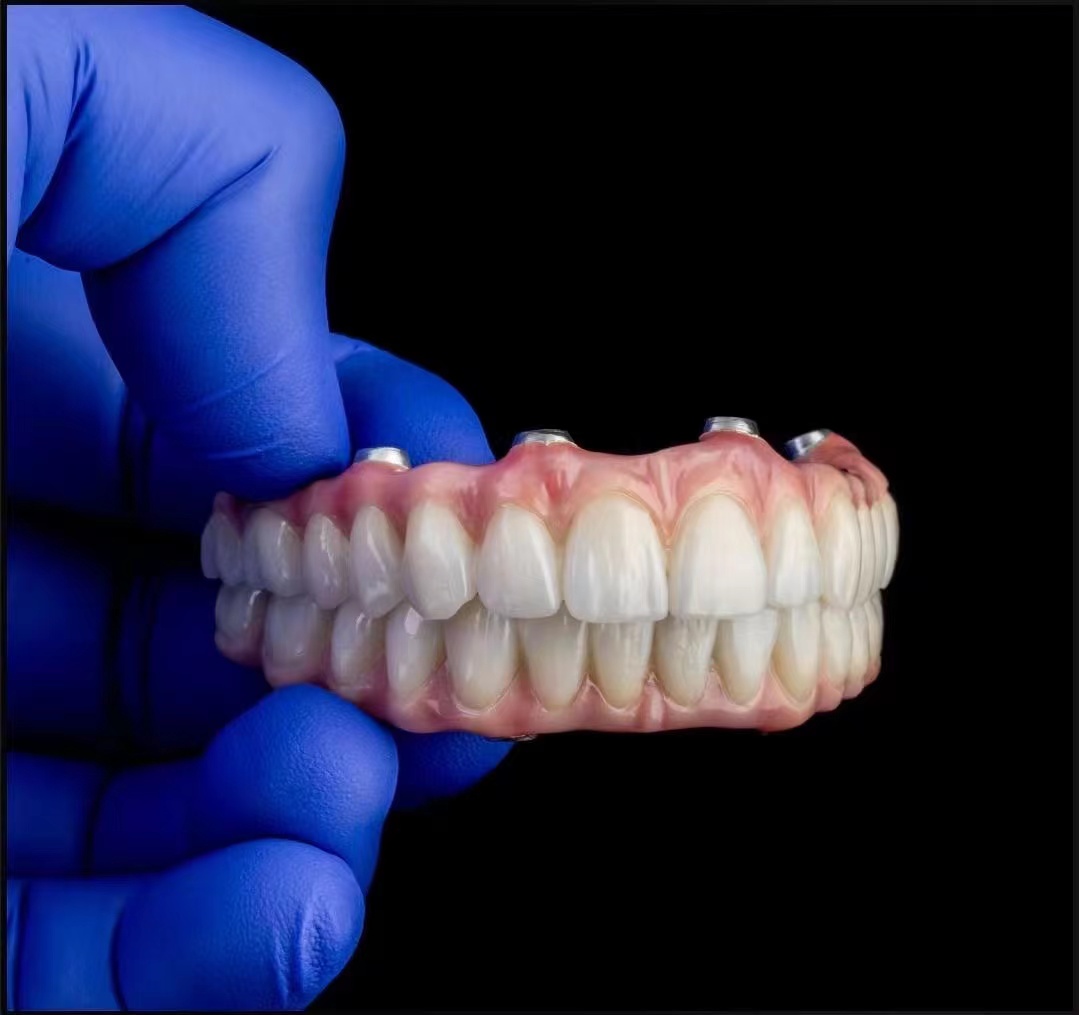 Implant Bridge